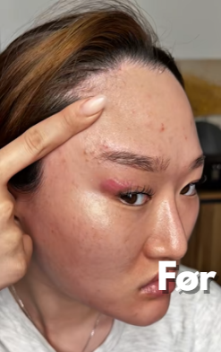 Voor foto - Irriteret hud